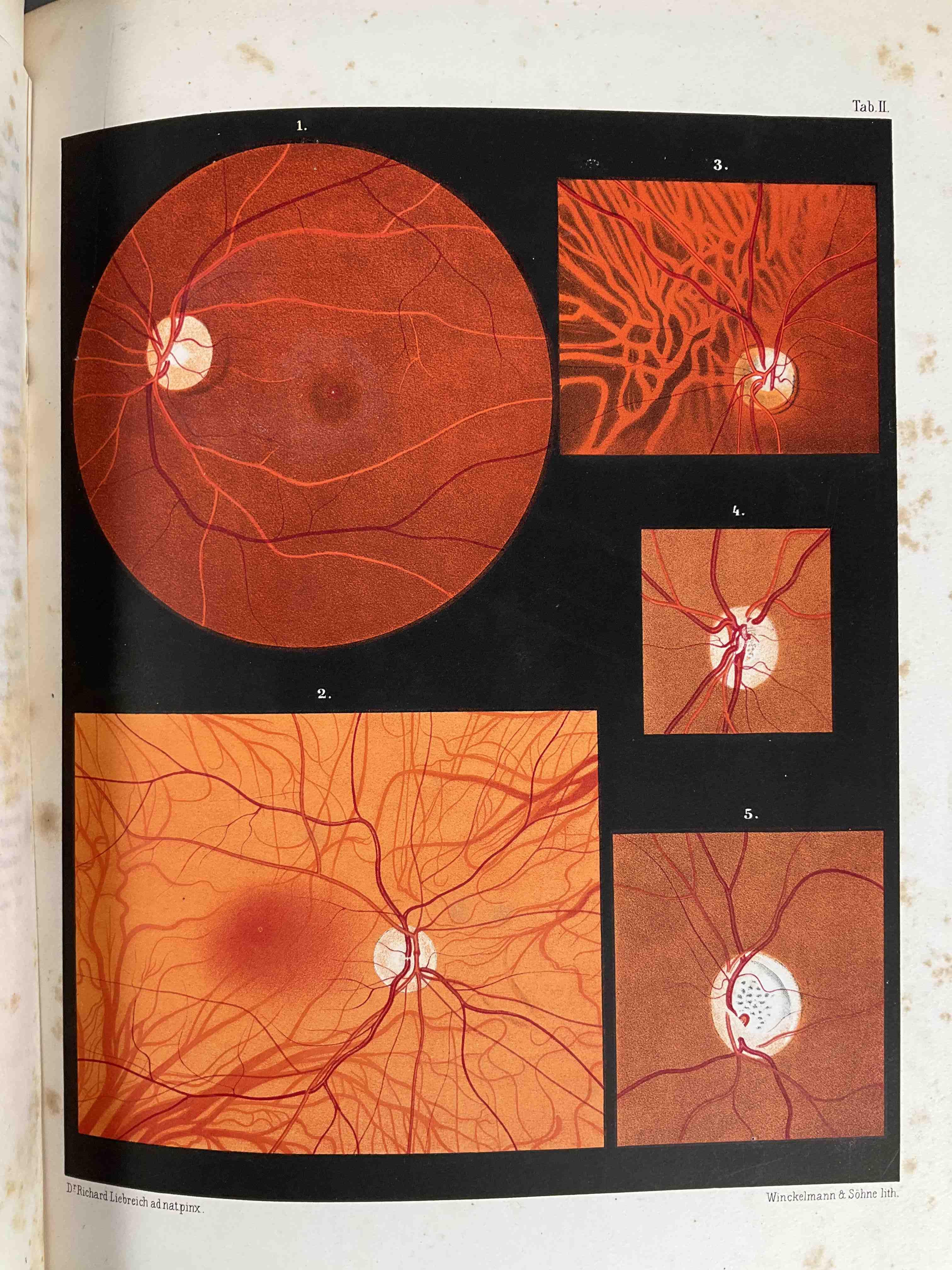 [Ophtalmologie] Richard Liebreich, Atlas d'ophtahalmoscopie représentant l'état normal et les...